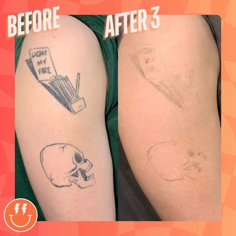 tattoo removal